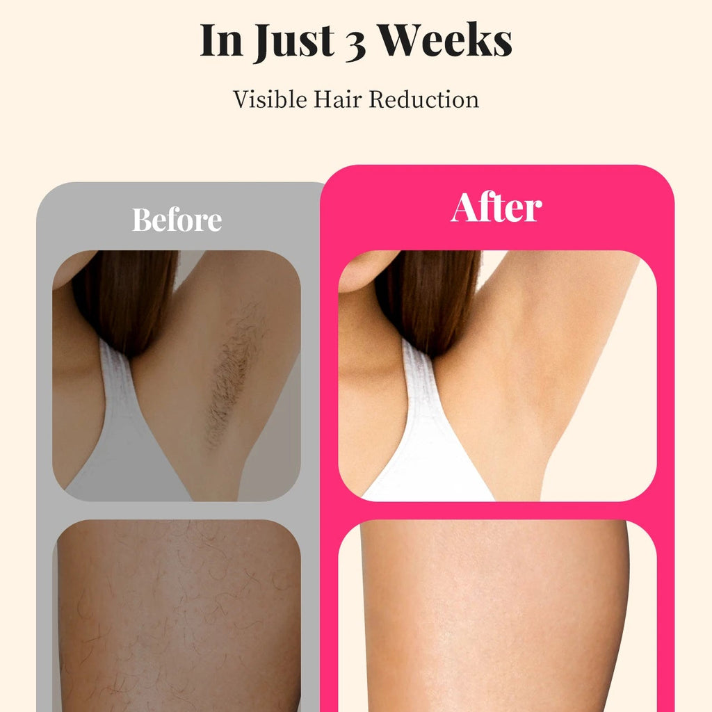 Isla Smooth™ IPL Hair Removal Device